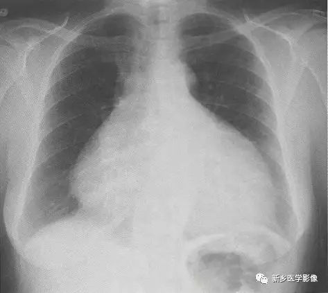 你必须了解的11种常见的心脏疾病！ 的插图-5