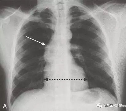 你必须了解的11种常见的心脏疾病！ 的插图-4