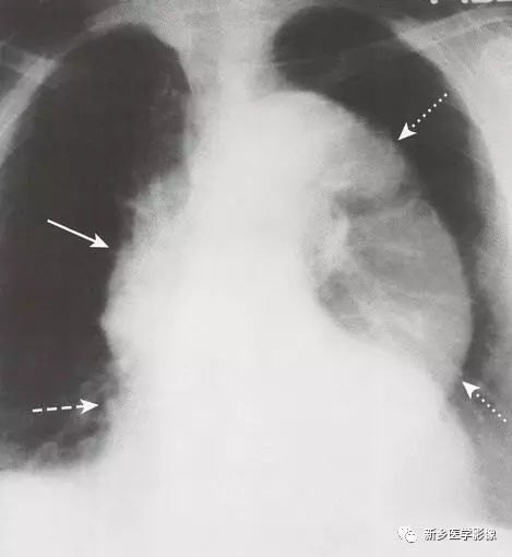 你必须了解的11种常见的心脏疾病！ 的插图-7